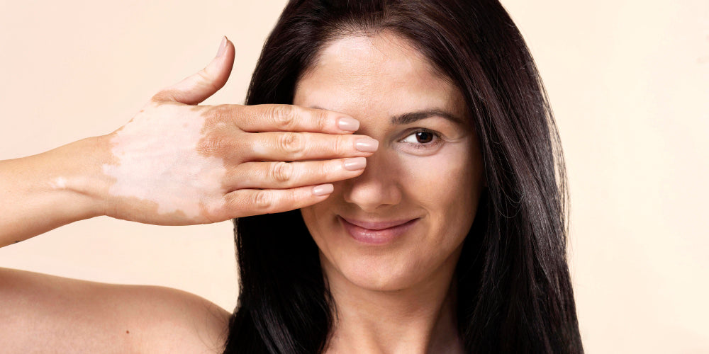 iperpigmentazione e fotoinvecchiamento