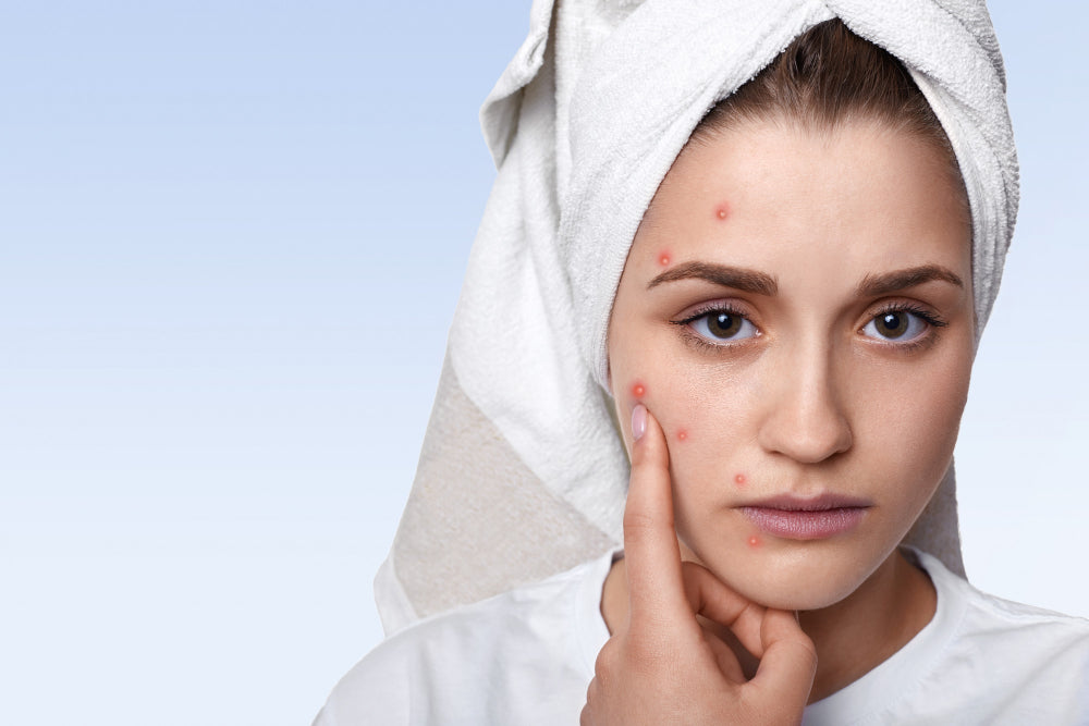 Brufoli da stress: Cause e i Rimedi per una Pelle Perfetta