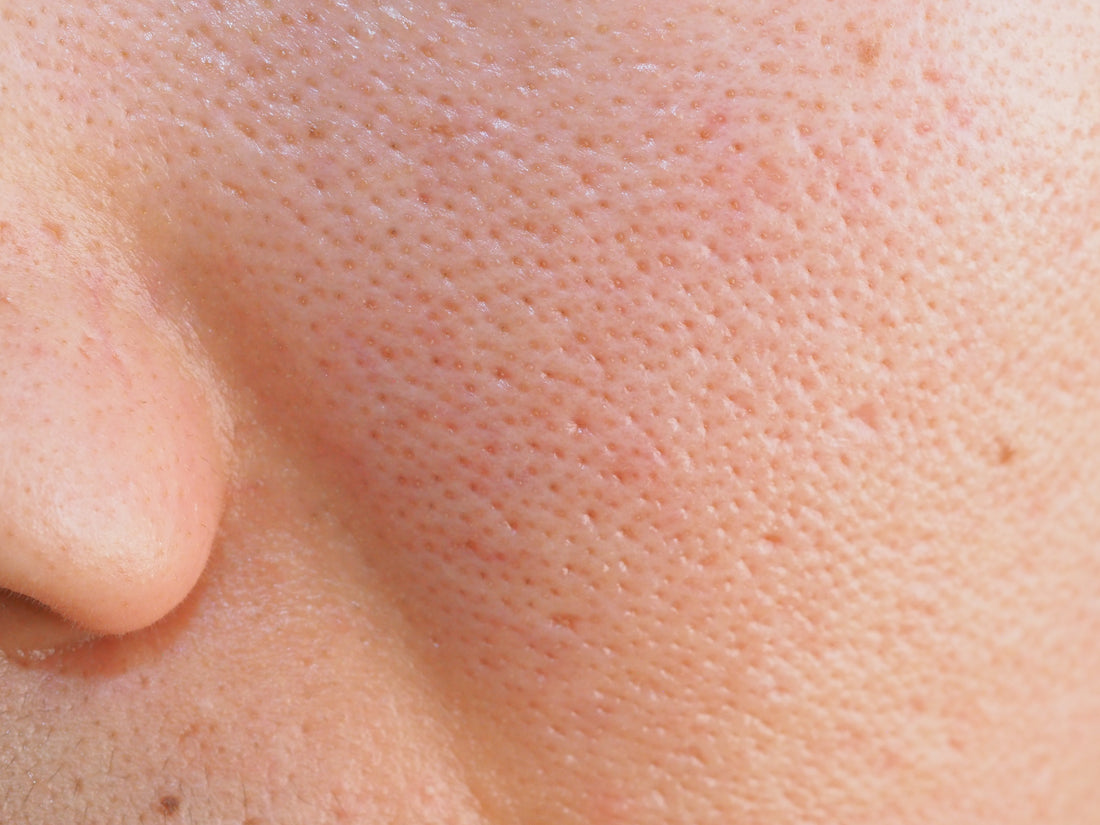 Come ridurre e minimizzare i pori dilatati